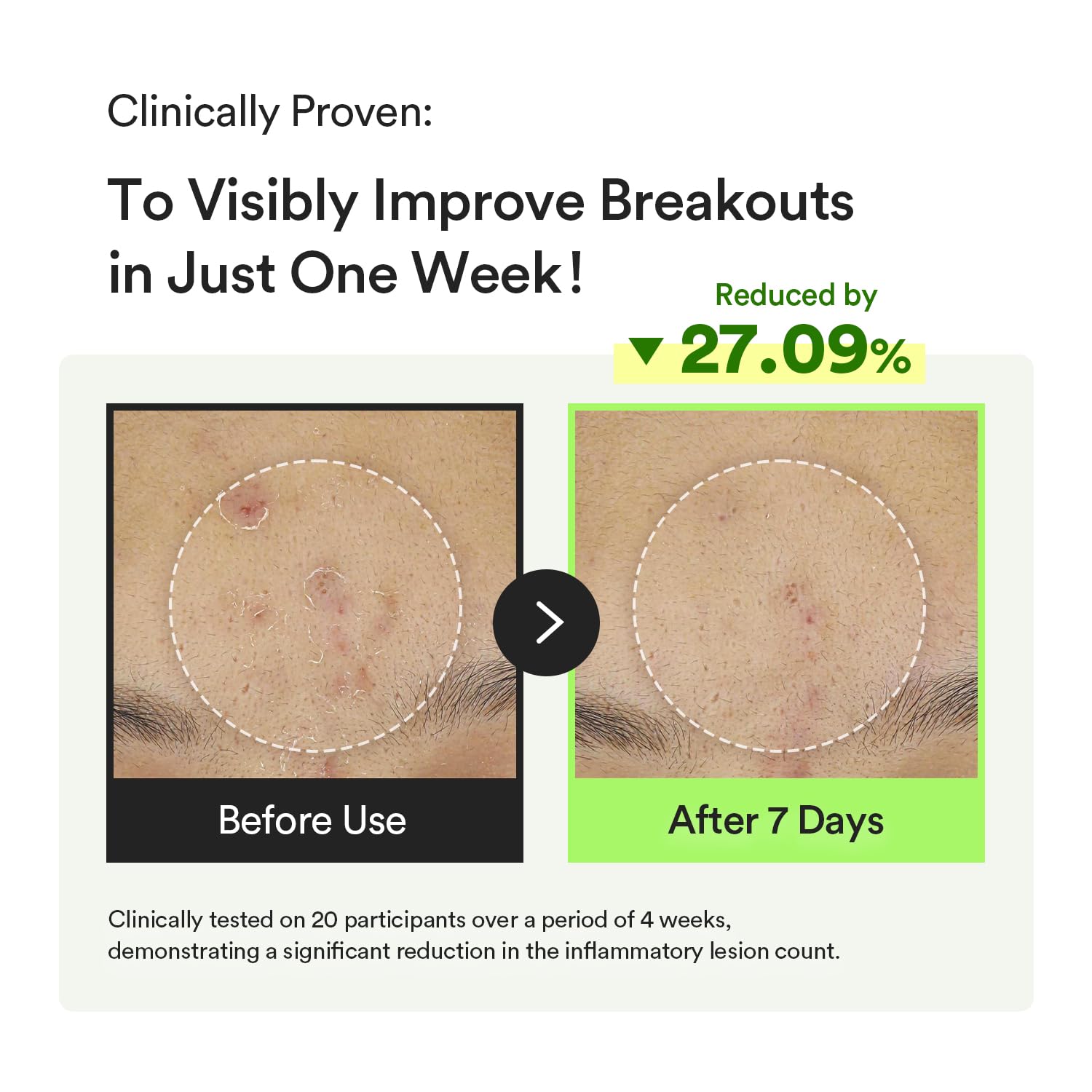 Abib Soothing Acne Care Duo: Heartleaf Teca Capsule Serum Calming Drop & Heartleaf Spot Pad Calming Touch 80pads I Centella Asiatica & Niacinamide Serum, Toner Pads for Sensitive Skin - Image 3